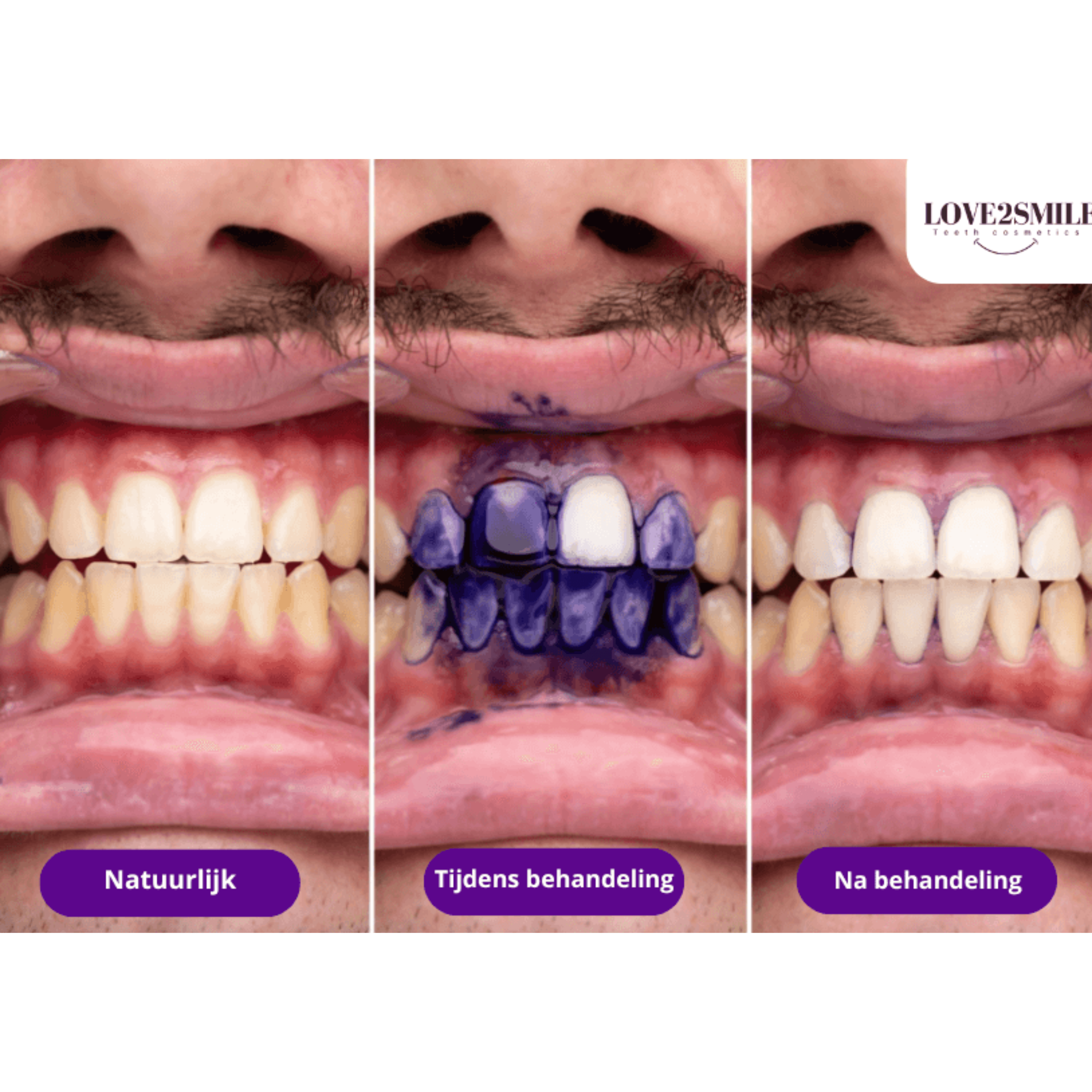 love2smile before after